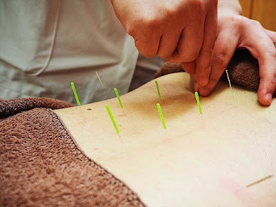 Oedoshinkyu Acupuncture 사진 3