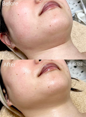 【たるみ・肌質改善サロン】小さな美肌研究室 사진 3
