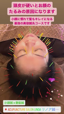 Acupuncture salon LINOA Rinoa Acupuncture 사진 3