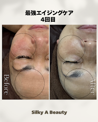 Silky A Beauty 【シルキーエービューティー】浅草 脱毛/肌質改善フェイシャルエステ Hair removal, skin quality improvement facial 사진 2