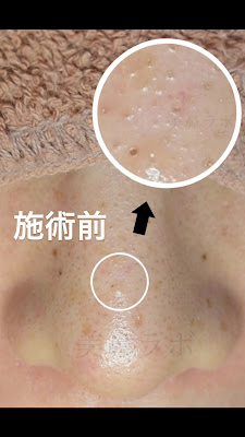 ［美鼻ラボ］ 毛穴ケア/まつ毛パーマ | Facial & Eyelash Perm Beauty Salon in Tokyo 사진 3