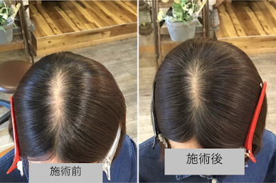 네리마구 인간줄기세포 발모육모 헤드스파 살롱 사진 3