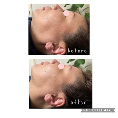 小顔矯正me 사진 5