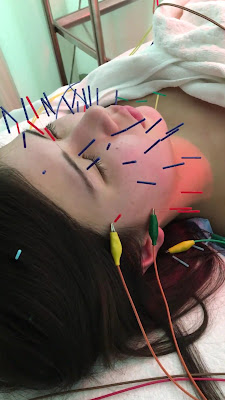 Hide Acupuncture 사진 2