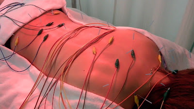 Hide Acupuncture 사진 3