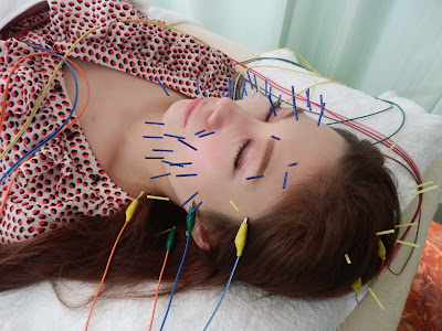 Hide Acupuncture 사진 4