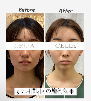 小顔矯正＋ヘッドスパ＋ハイフ(HIFU) CELIA 사진 4