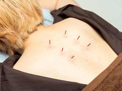 RUN FIT Harikyuin Acupuncture 사진 3