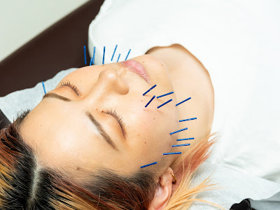 RUN FIT Harikyuin Acupuncture 사진 5
