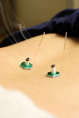 Koyorishinkyu Acupuncture 사진 3