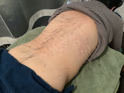 Kaminoge Ekimae Seikotsuin Acupuncture 사진 5
