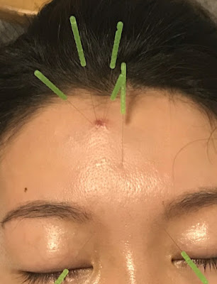 Hikarishinkyu Acupuncture 사진 3