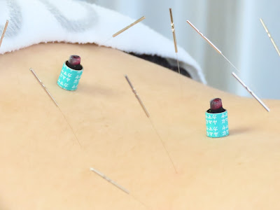 Saigashinkyu Acupuncture 사진 5