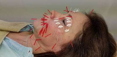 Hidamariharikyuin Acupuncture 사진 5