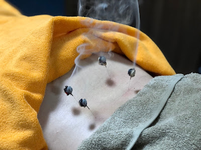 Asagayashishimai Shinkyuin Acupuncture 사진 3