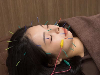 No . 10 Acupuncture 사진 2