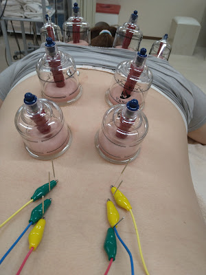 Komatsutoriseikotsuin Acupuncture 사진 2