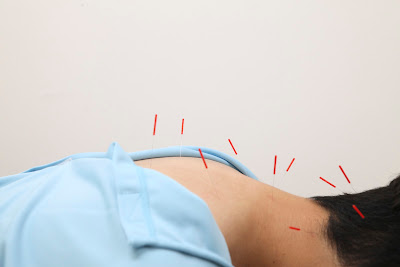 Motohasunumarikabashinkyu Acupuncture 사진 4