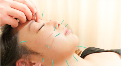 Umejima Ekimae Shinkyu Acupuncture 사진 4