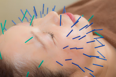 Theracua Acupuncture Clinic 사진 3