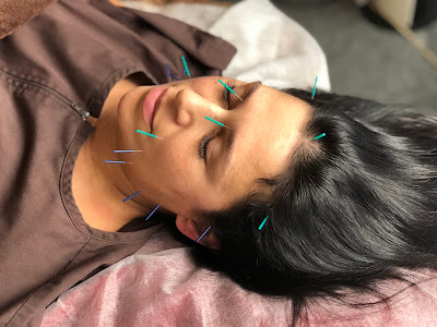 Tsukioka Acupuncture 사진 3