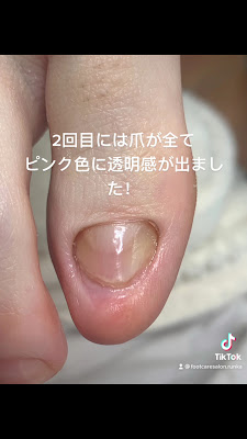 フットケアサロンランカ/銀座巻き爪矯正センター 사진 5