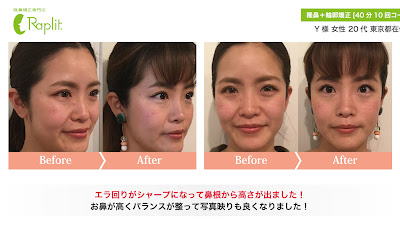 隆鼻矯正専門店 Raplit 美鼻＆小顔 銀座店【ラプリ】 사진 2