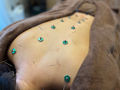 Murakami Acupuncture 사진 4