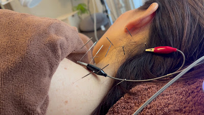 Murakami Acupuncture 사진 2