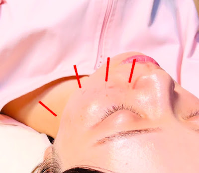Elle Acupuncture Therapy Ikebukuro 사진 4