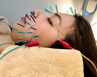 Cell Fitto Acupuncture 사진 2