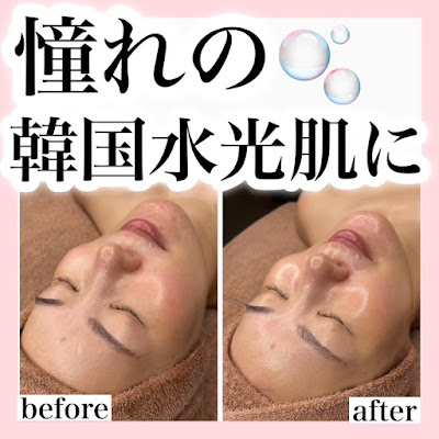 毛穴・ニキビケア ハーブピーリング【肌管理専門店】WHITE AQUA 錦糸町店 사진 4