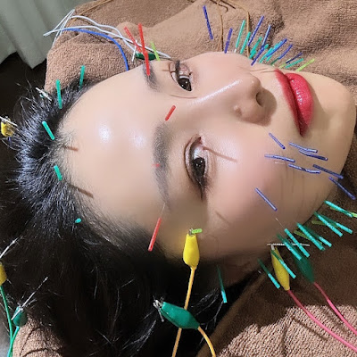 Spring Acupuncture 사진 2