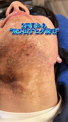 メンズ脱毛 salon and. (アンドット) 사진 2