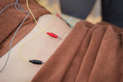 Harikuru (Haricle) Acupuncture 사진 3