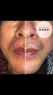 中島式メンズ脱毛サロン NARX ナークス 사진 3