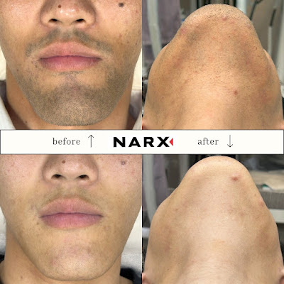 中島式メンズ脱毛サロン NARX ナークス 사진 5